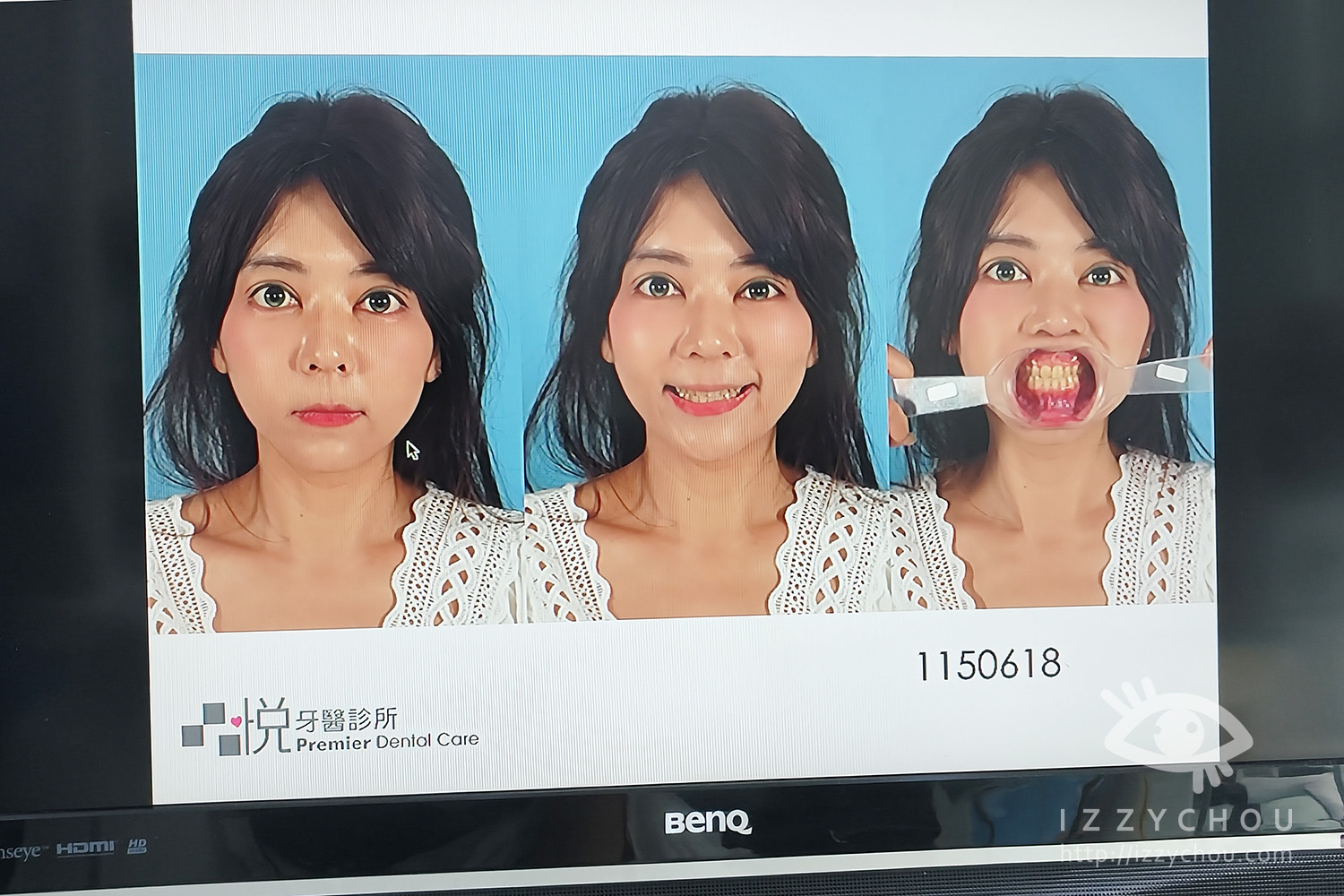 隱適美前必看!竹北牙齒矯正推薦心得:數位口掃建檔+矯正諮詢全紀錄【品悅牙醫診所|竹北牙醫推薦】 - 第31張圖 隱適美前必看!竹北牙齒矯正推薦心得:數位口掃建檔+矯正諮詢全紀錄【品悅牙醫診所|竹北牙醫推薦】